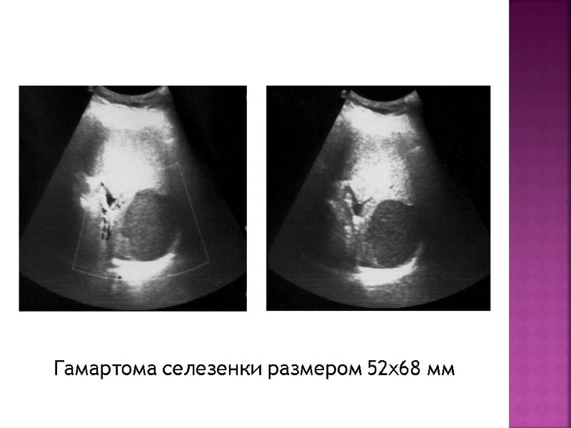 Гамартома селезенки размером 52х68 мм
